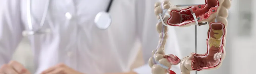 What is Colon Cancer?