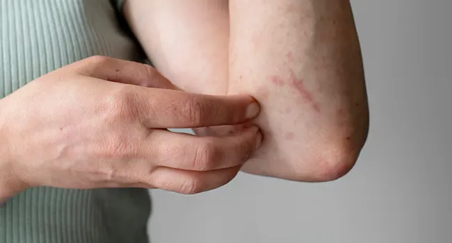 Hodgkin Lymphoma Symptoms and Causes Image 2